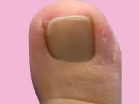 ingroeiende nagel van grote teen